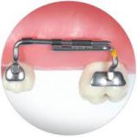 Kit Mantenedor espaço (c/ 4peças)